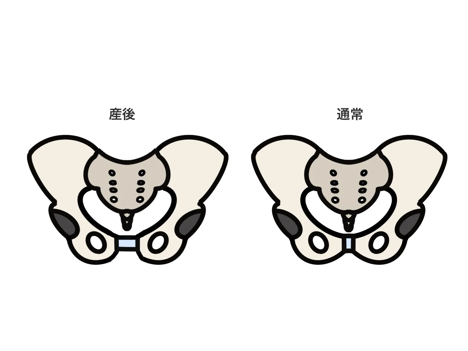 産後に開いた骨盤まわりを示すイラスト。出産後は骨盤を支える筋肉のバランスが崩れやすい