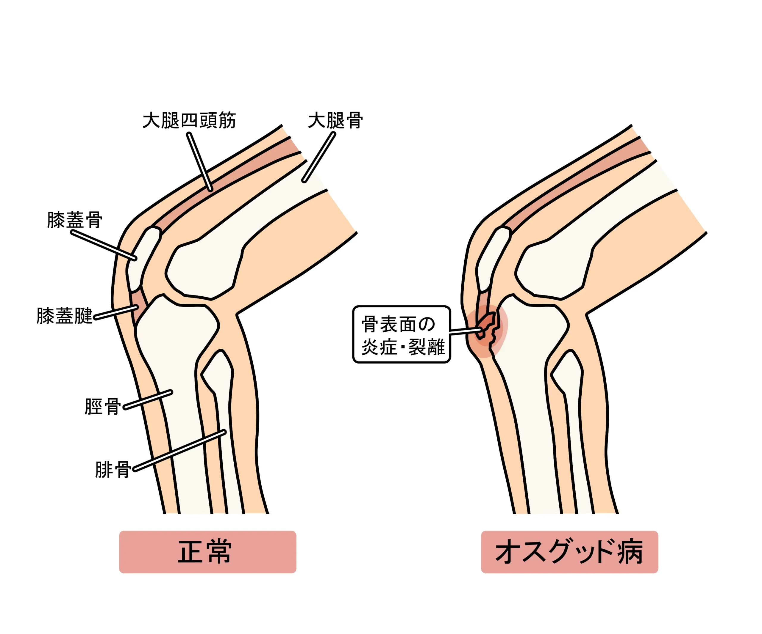 成長期に膝のお皿の下が痛むオスグッドのイラスト。走る・ジャンプ・しゃがむ動作で痛みが出やすい